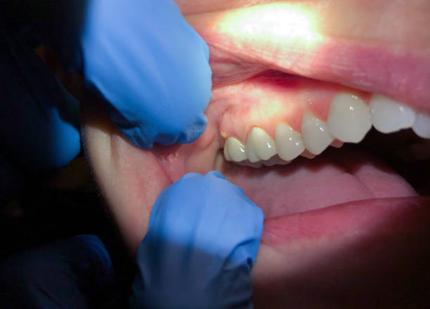 Best Emergency Tooth Extraction in Glenwood, AR
